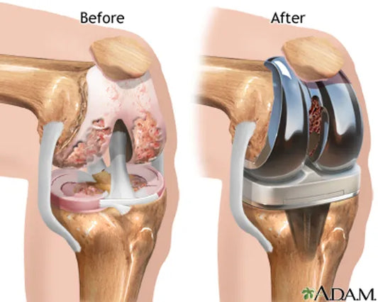 Consultant , Joint replacement surgery